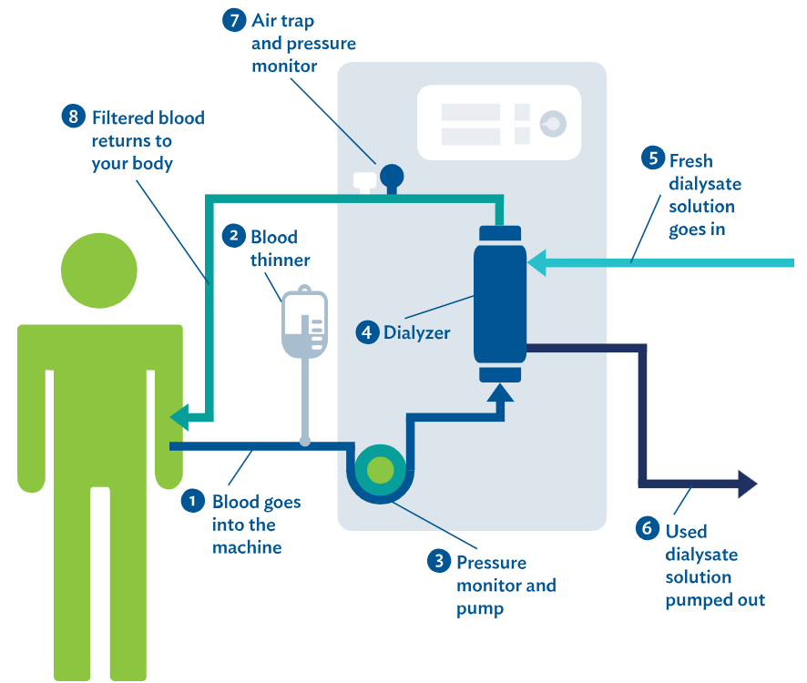 hemodialysis